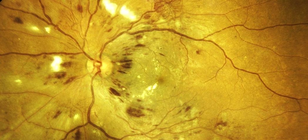 Diabetische Retinopathie - Fundusaufnahme mit Netzhautblutungen