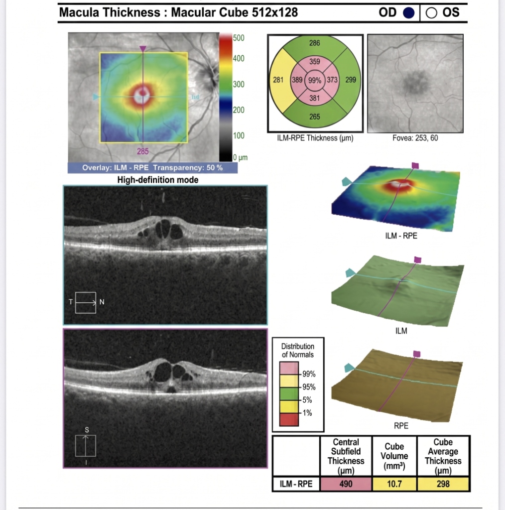 Dickenanalyse der Makula (Macular Cube)