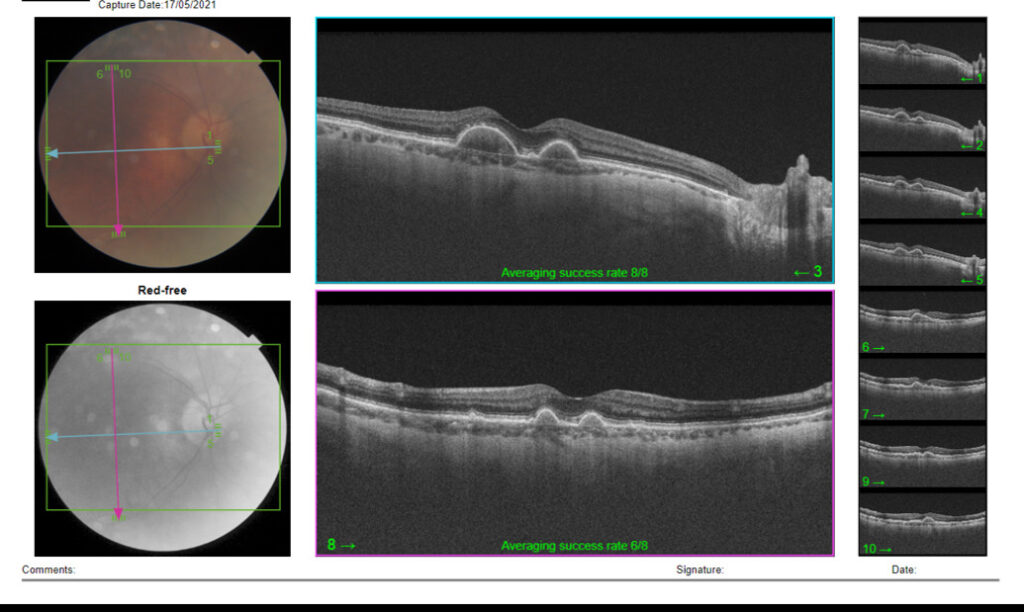 OCT Ouläre Kohärenz-Tomographie Befundbericht