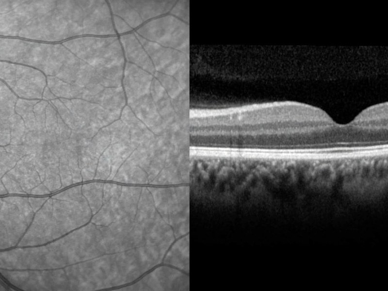 Makuladegeneration (AMD) in Ludwigshafen: Symptome und Früherkennung